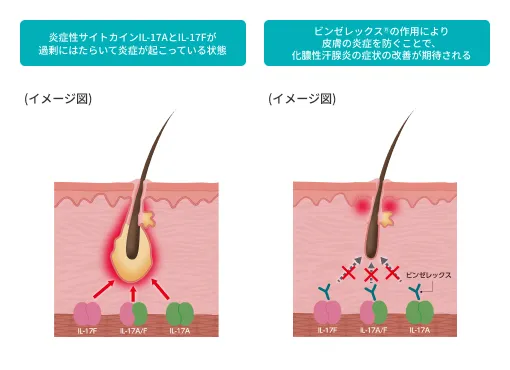 IL-17AとIL-17Fによる炎症が起こる状態と、ビンゼレックスがそれらを抑えて皮膚の炎症を防ぐ仕組みを示した図