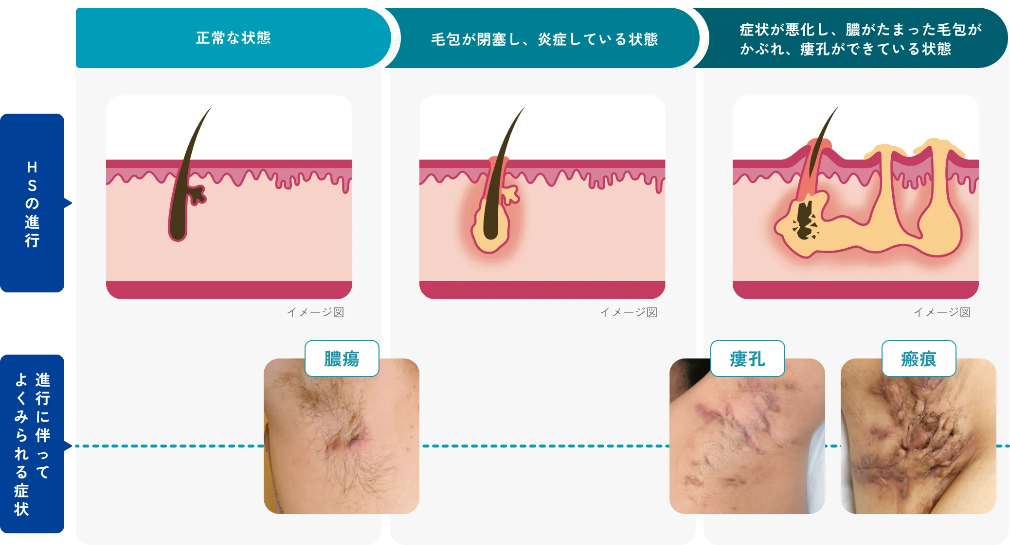 HSの進行過程と、膿瘍・瘻孔・瘢痕などの症状を示した図