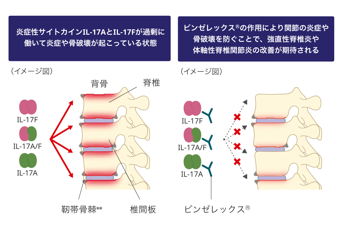ビンゼレックスがIL-17A/IL-17Fを抑えて炎症や骨破壊を防ぐ作用のイメージ図