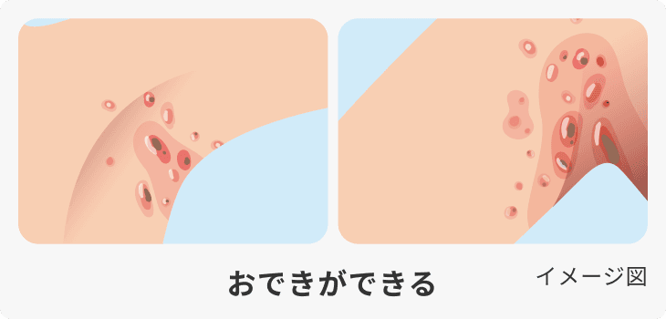 化膿性汗腺炎(HS)のおできができ進行した状態を示した図
