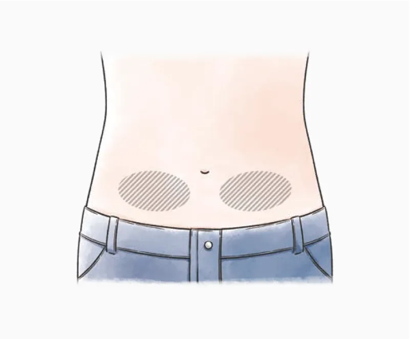 自己注射の投与部位を示すイラスト。へそより下の左右下腹部が投与部位として示されている。