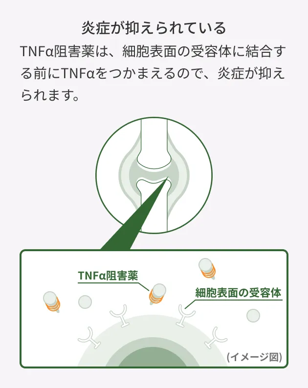 TNFα阻害薬がTNFαを捕まえ、細胞表面の受容体への結合を防ぐことで、関節の炎症を抑えるしくみを示したイメージ図