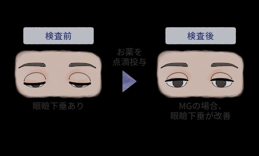 薬剤投与により眼瞼下垂の改善を確認するエドロホニウム試験を示す図