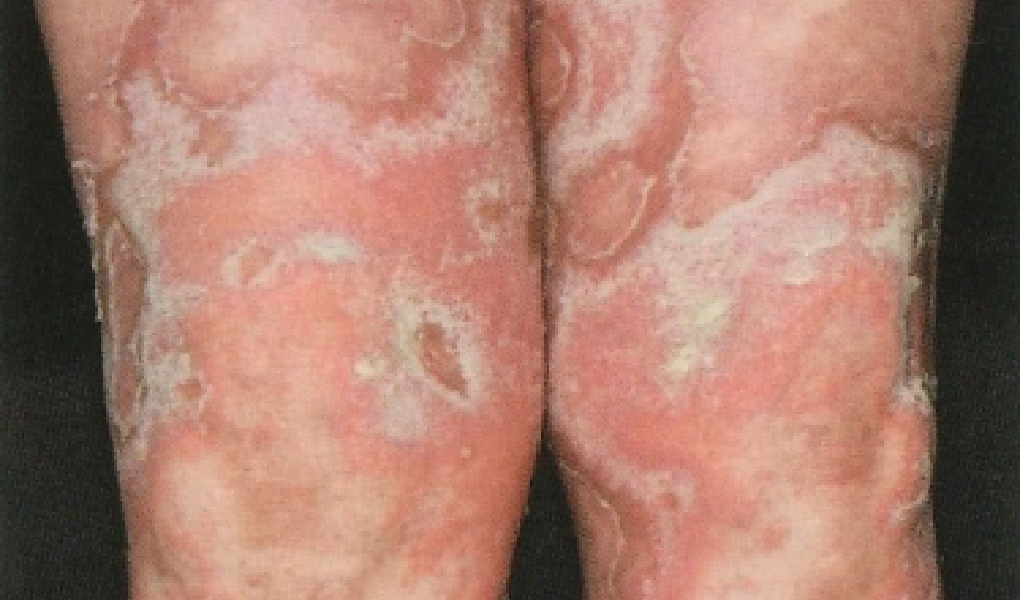 乾癬患者の両脚に赤みと多数の膿疱がみられる写真