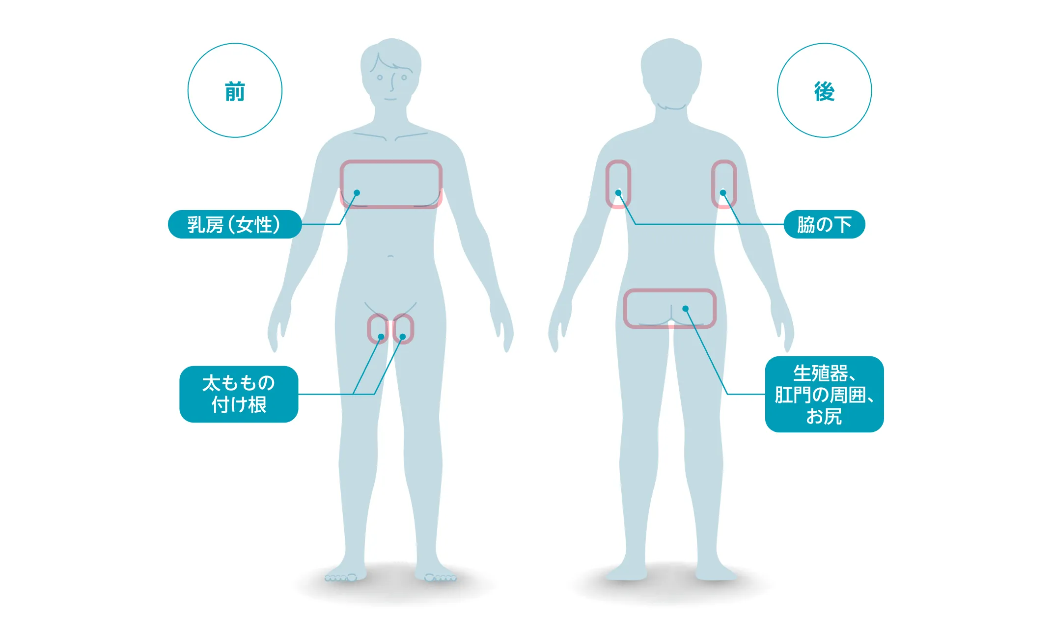 HSができやすい部位を示す図。脇の下、乳房(女性)、太ももの付け根、外陰部・肛門周囲・お尻などに発症しやすい