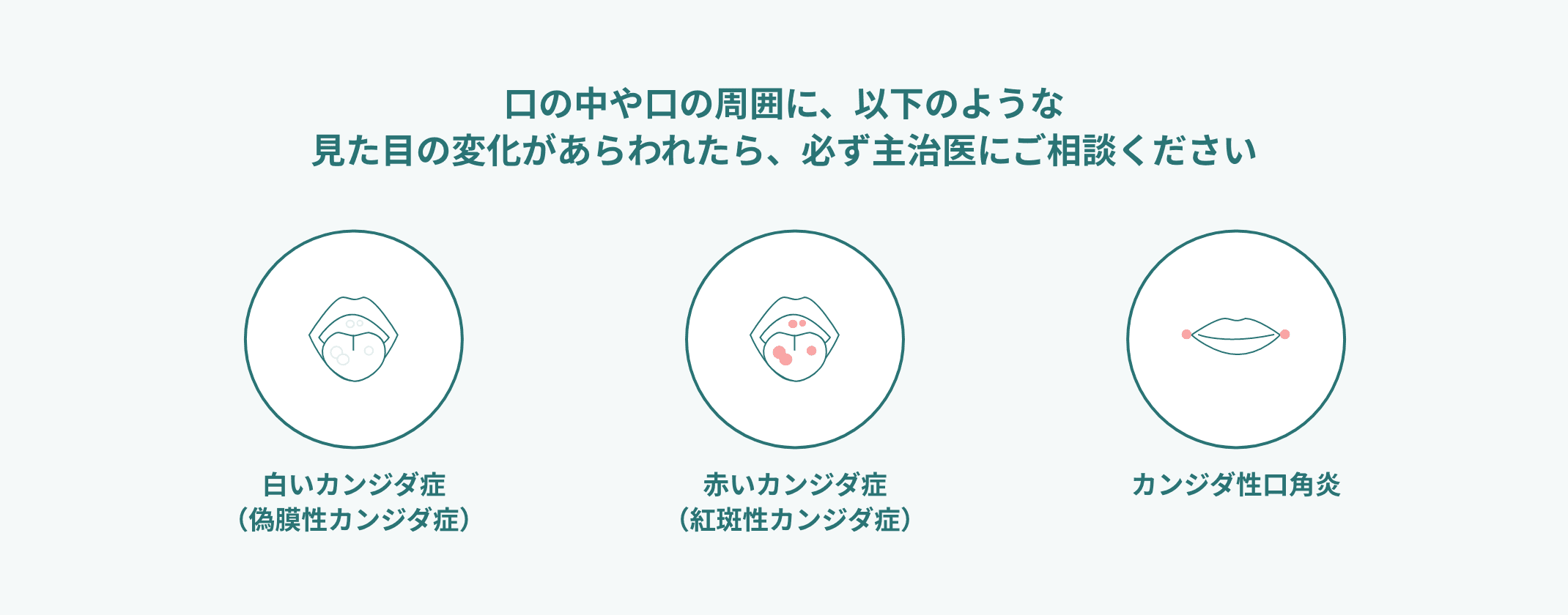 口の中や口の周囲に、以下のような見た目の変化があらわれたら、必ず主治医にご相談ください 白いカンジダ症(偽膜性カンジダ症) 赤いカンジダ症(紅斑性カンジダ症) カンジダ性口角炎