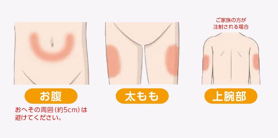 シムジア®の投与部位を示した図