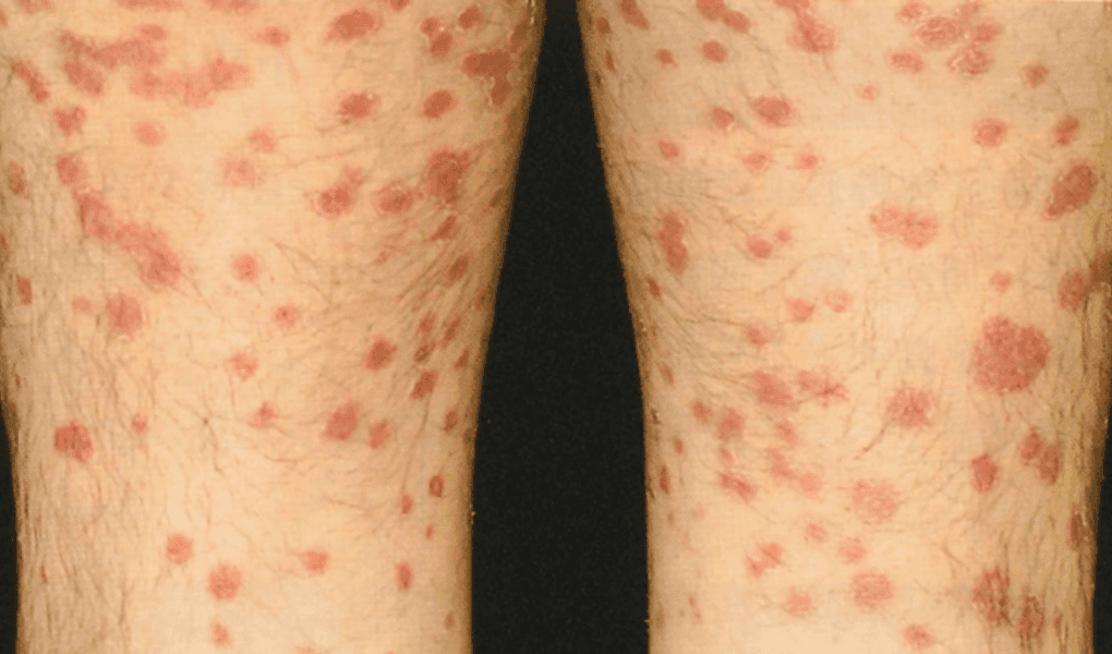 乾癬患者の両下肢に小さな赤い発疹が多数みられる様子の写真