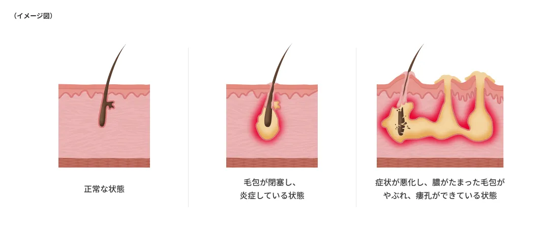化膿性汗腺炎の発症の流れ(毛穴の詰まりから炎症が起こり、膿がたまって瘻孔ができるまで)を示した図