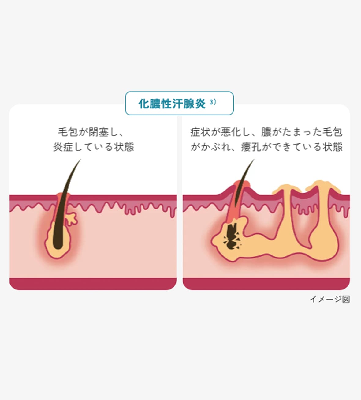 化膿性汗腺炎のイメージ図