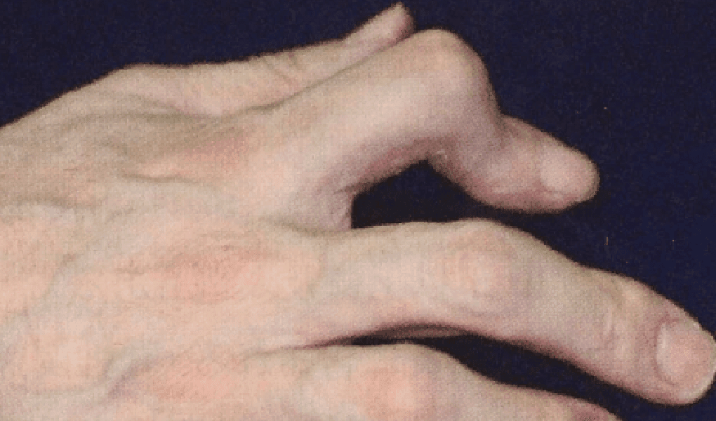 乾癬患者の手指の関節が変形している様子の写真