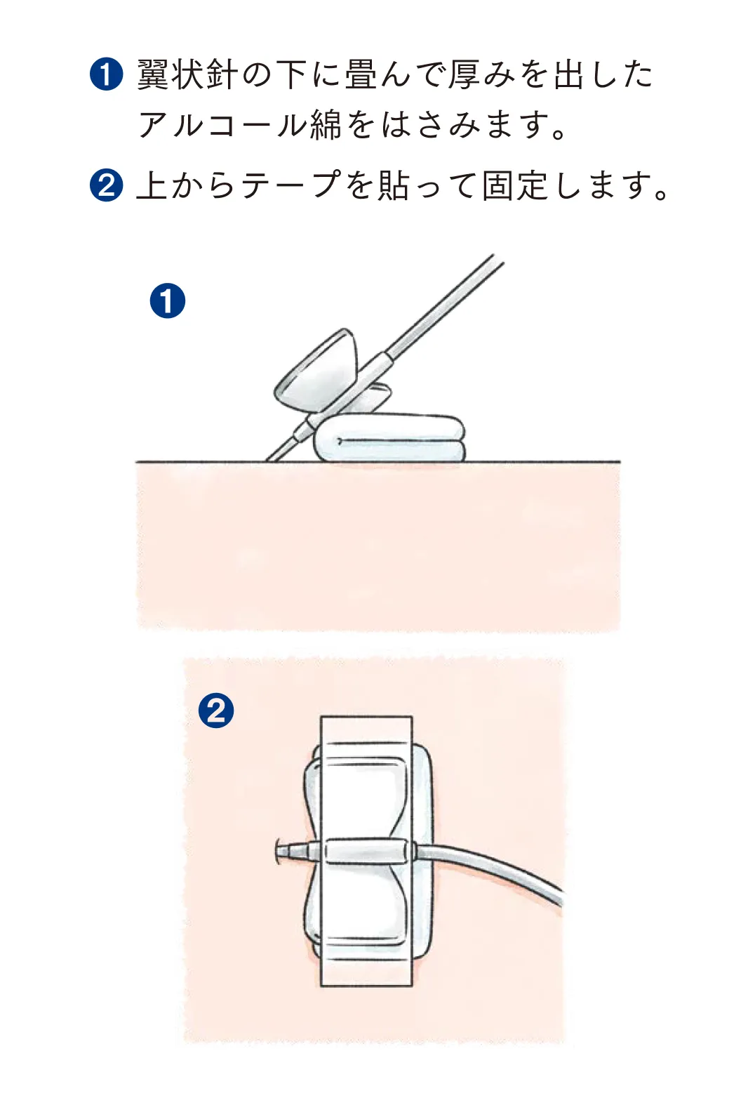 翼状針の固定方法。アルコール綿を挟み、固定テープで固定する手順を示している。