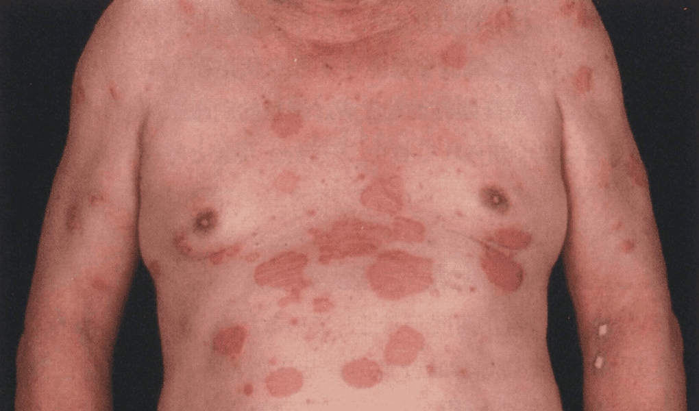 乾癬患者の胸部に赤い丸い皮膚の変化が多数みられる写真