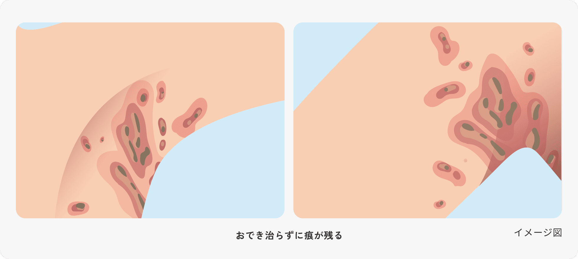 化膿性汗腺炎(HS)の症状で、より広く痕が残った状態を示した図