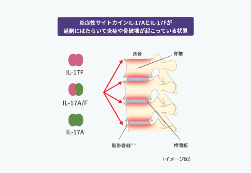 IL-17AやIL-17Fの作用により脊椎の関節で炎症や骨破壊が起こる仕組みのイメージ図