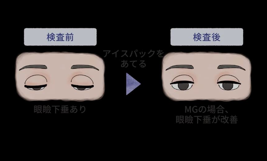 アイスパックで冷却して眼瞼下垂の改善を確認する検査を示す図