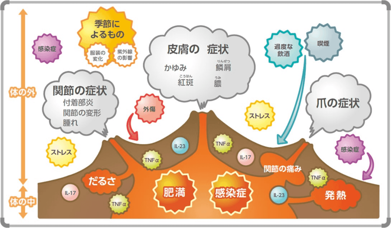 乾癬の発症の仕組みを示した模式図