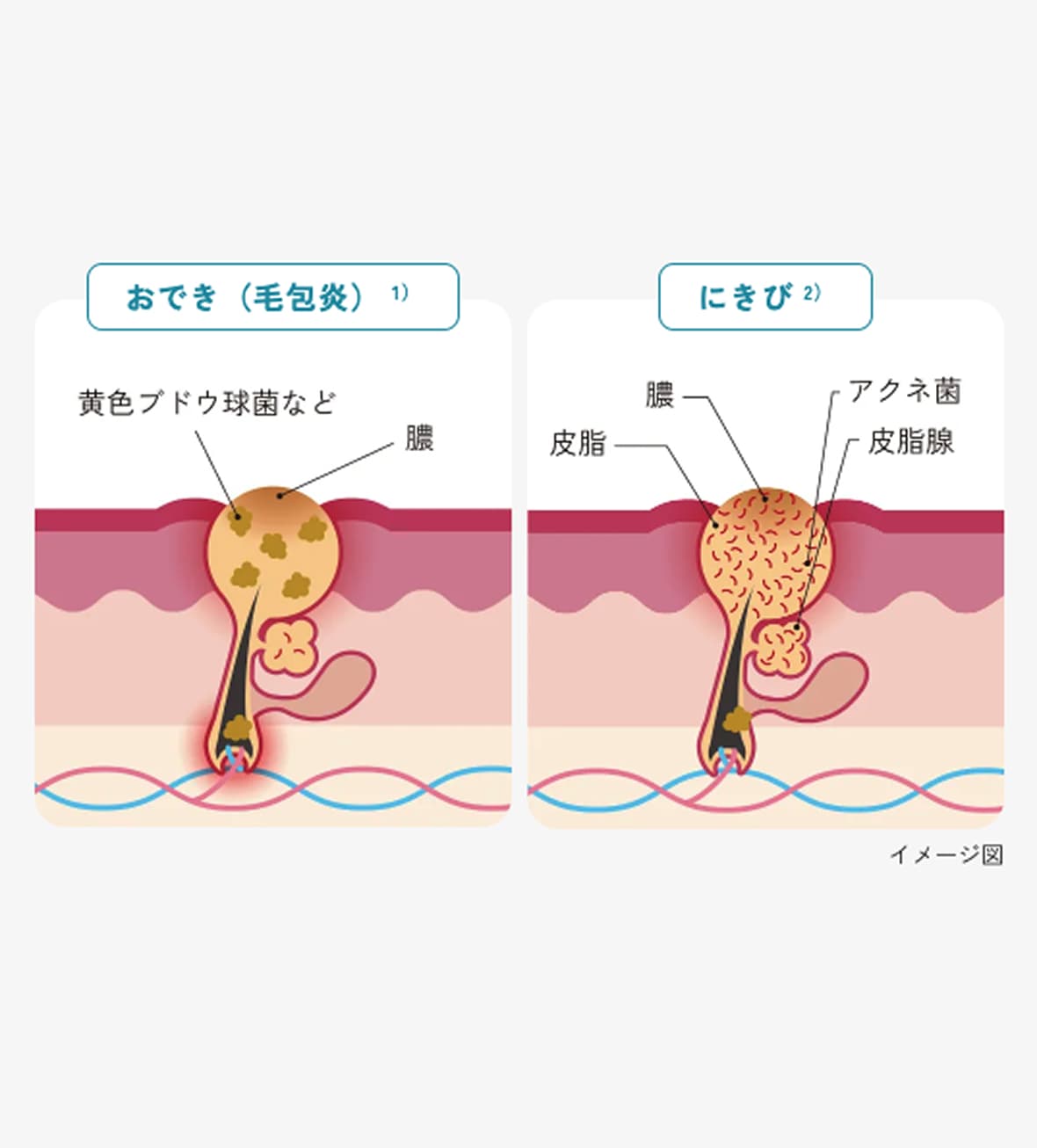 毛包炎(おでき)とにきびのイメージ図