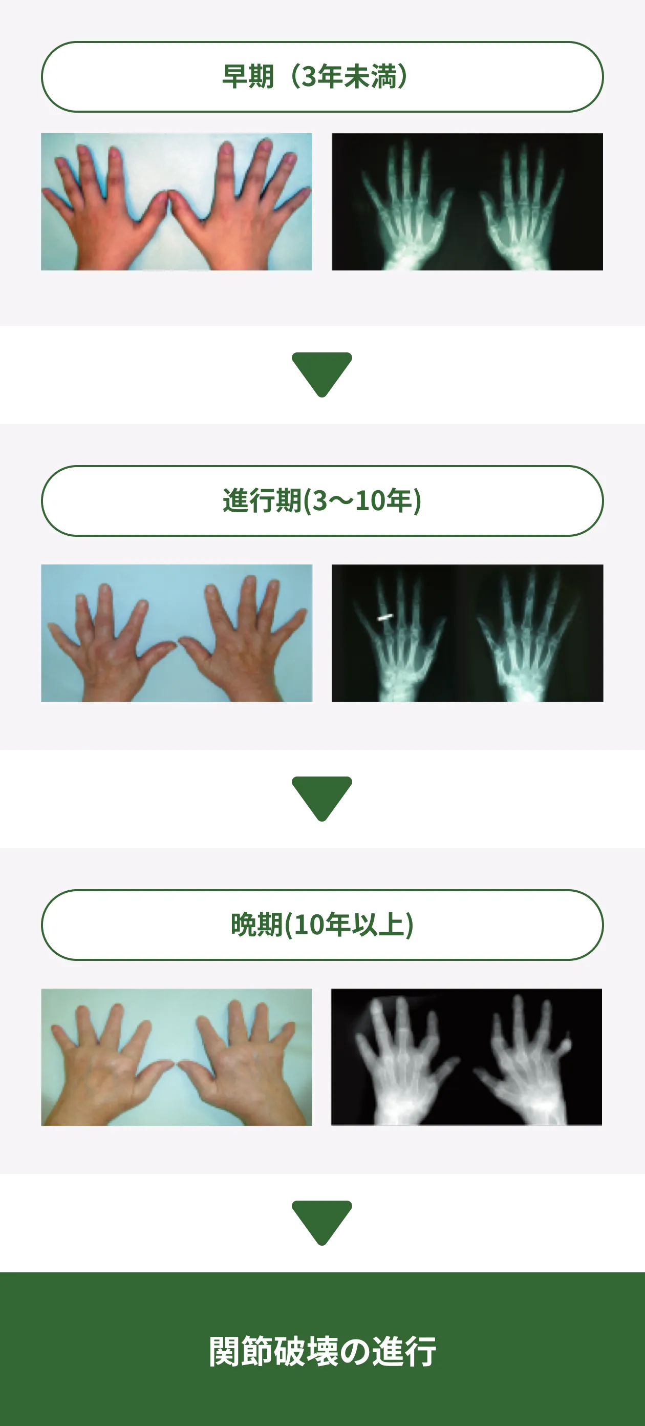 関節リウマチによる手の変化を、外観写真とX線画像で比較。早期(3年未満)、進行期(3~10年)、晩期(10年以上)の例を示し、関節の変形や関節破壊が進む様子を表している。