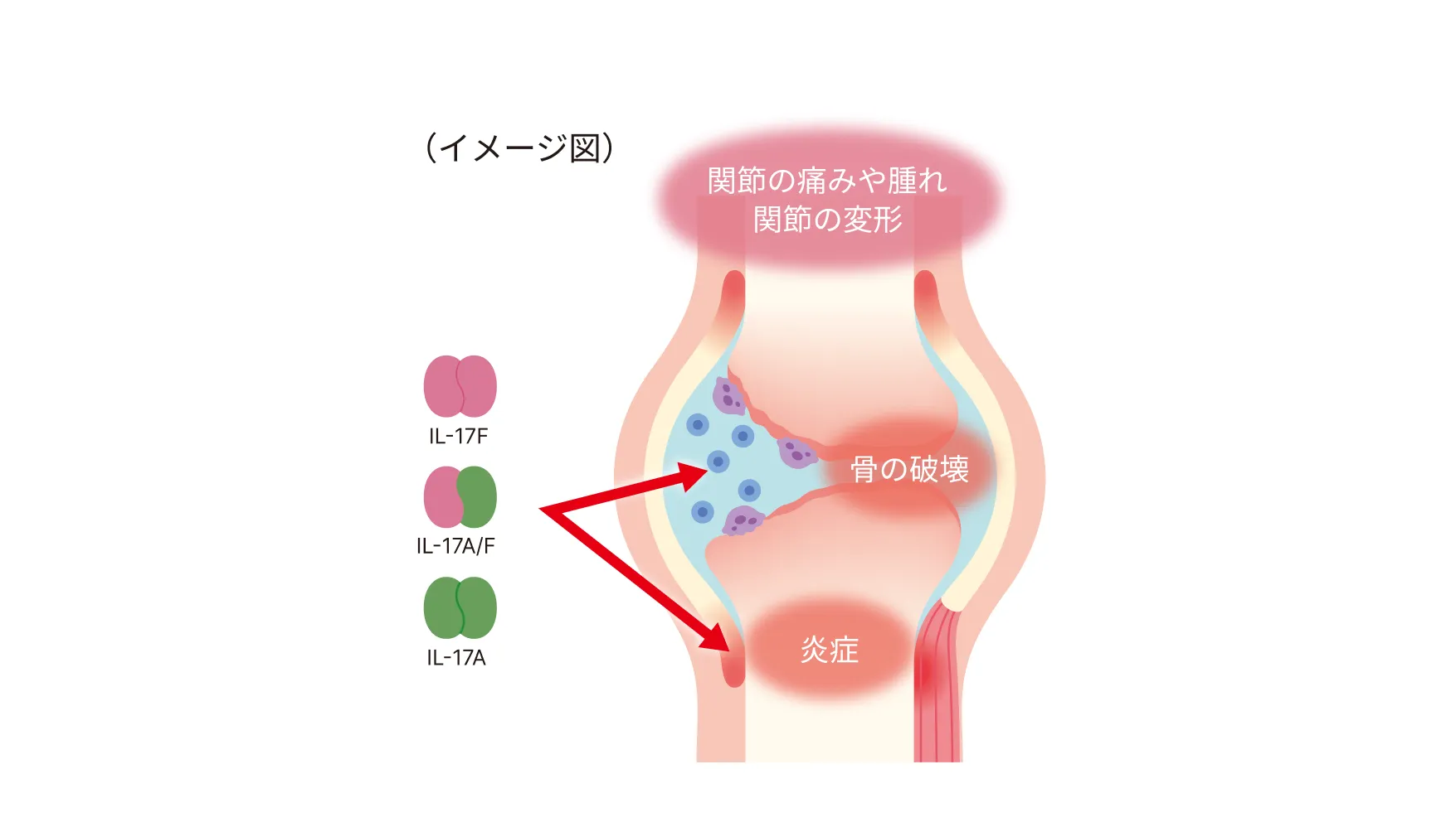 乾癬性関節炎の発症の仕組みを説明する関節の断面図