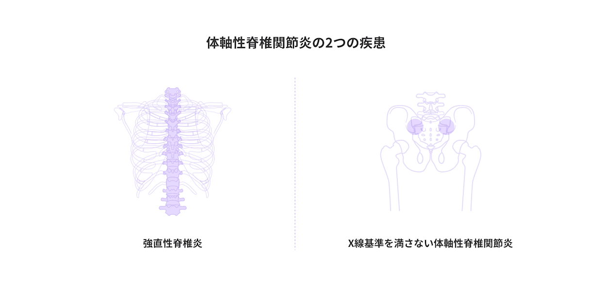 体軸性脊椎関節炎は「強直性脊椎炎」と「X線基準を満たさない体軸性脊椎関節炎」の2種類に分類されることを示す図