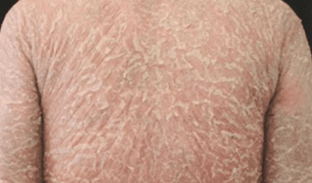 乾癬患者の両脚に赤みと多数の膿疱がみられる写真