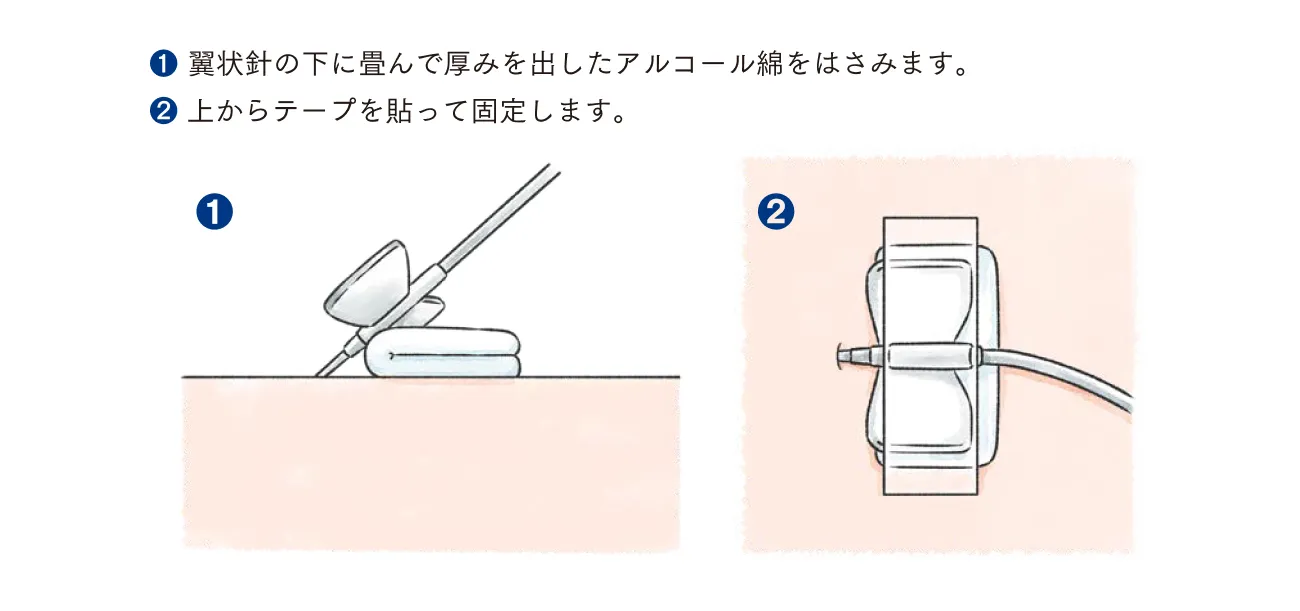 翼状針の固定方法。アルコール綿を挟み、固定テープで固定する手順を示している。