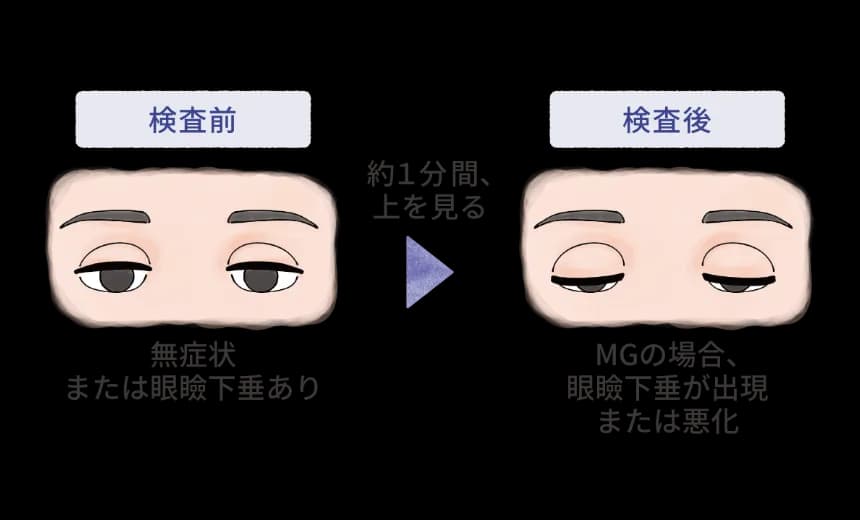 上を見続けることで眼瞼下垂が出るかを確認する検査(眼瞼の易疲労性試験)を示す図