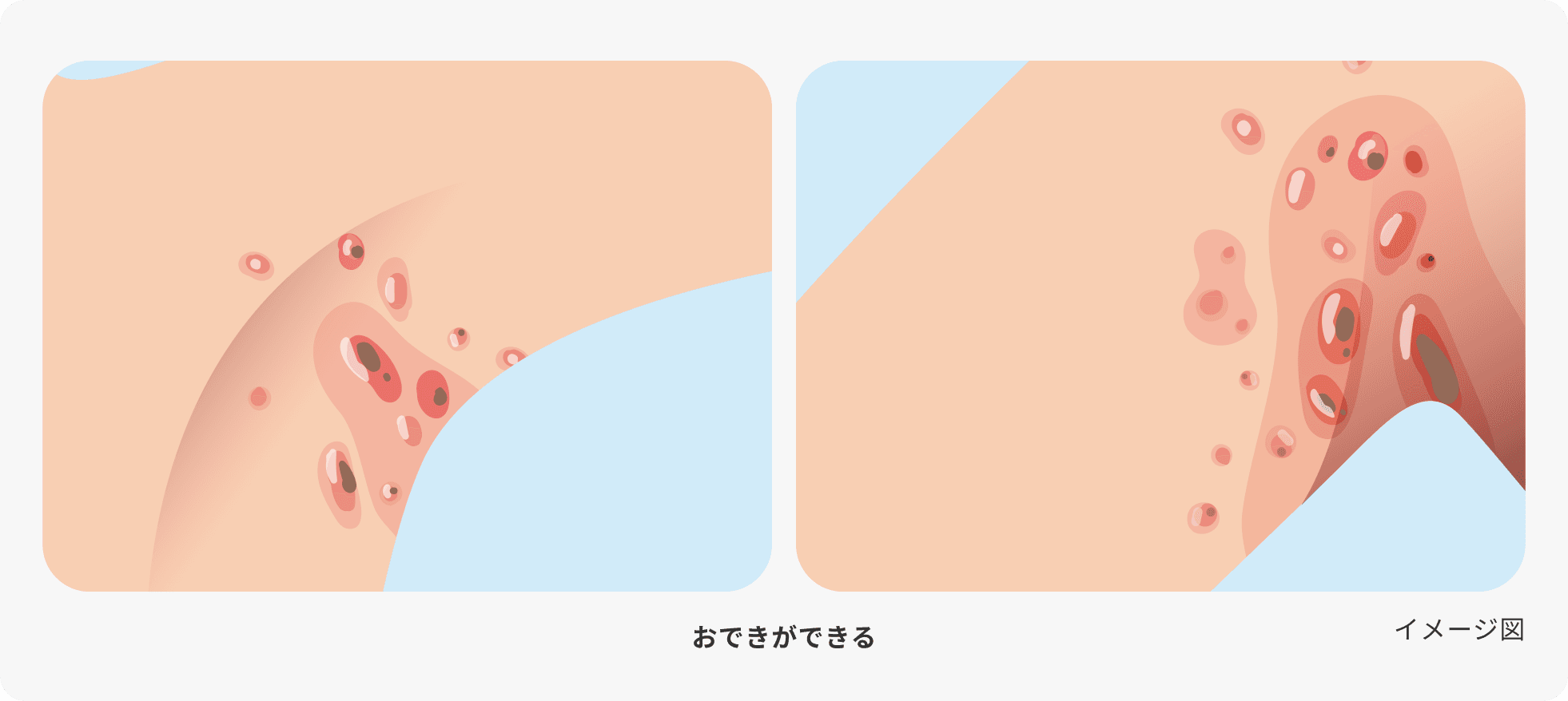 化膿性汗腺炎(HS)のおできができ進行した状態を示した図