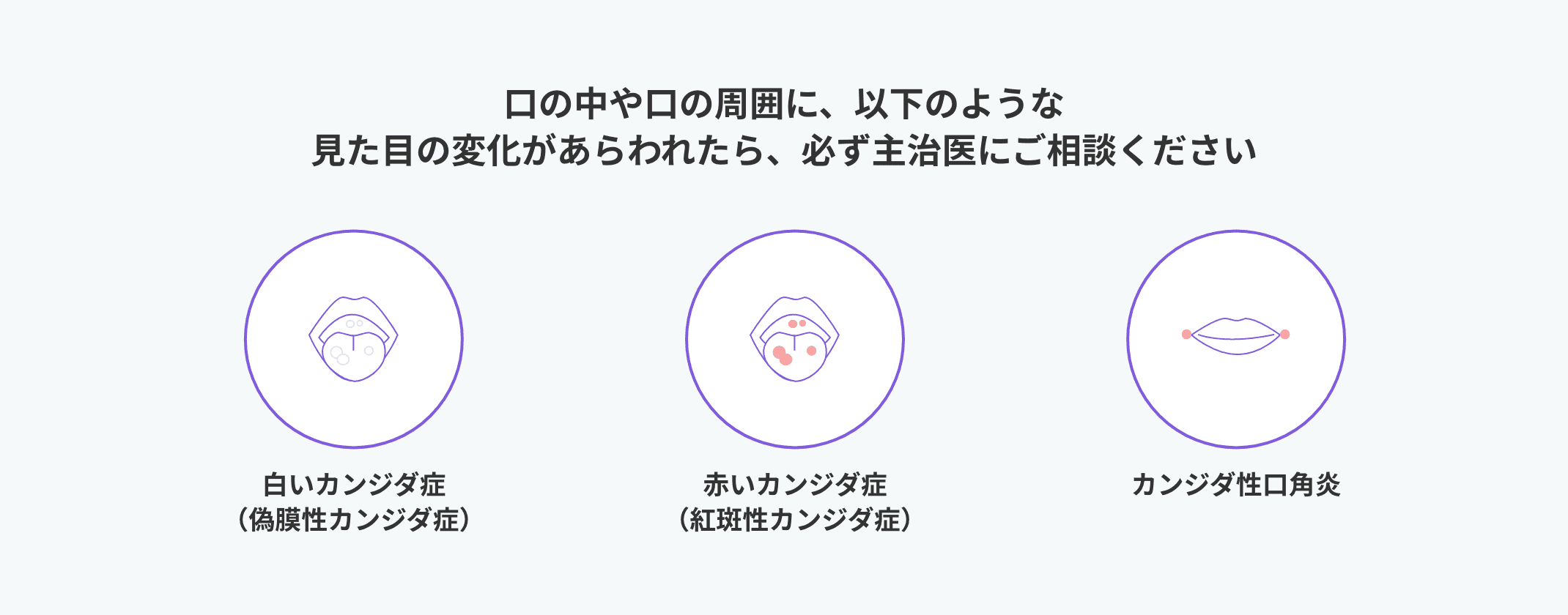 口の中や口の周囲に、以下のような見た目の変化があらわれたら、必ず主治医にご相談ください 白いカンジダ症(偽膜性カンジダ症) 赤いカンジダ症(紅斑性カンジダ症) カンジダ性口角炎