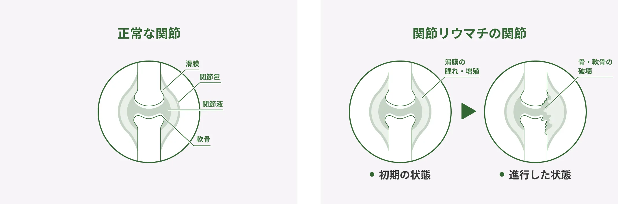 正常な関節と関節リウマチの関節の比較。正常な関節の構造として滑膜、関節包、関節液、軟骨を示す。関節リウマチでは、初期に滑膜が腫れ・増殖し、進行すると骨・軟骨が破壊される。
