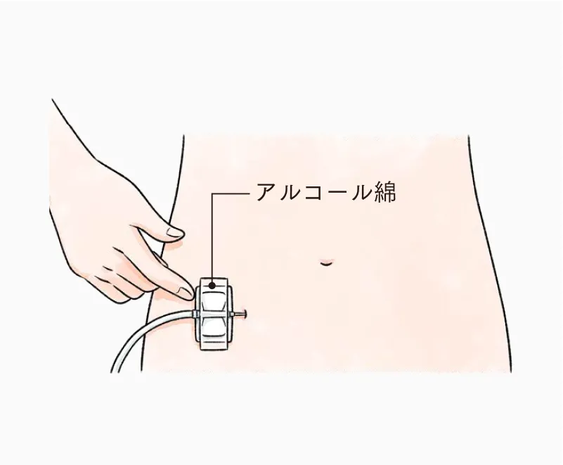アルコール綿と固定テープで翼状針を固定する様子。