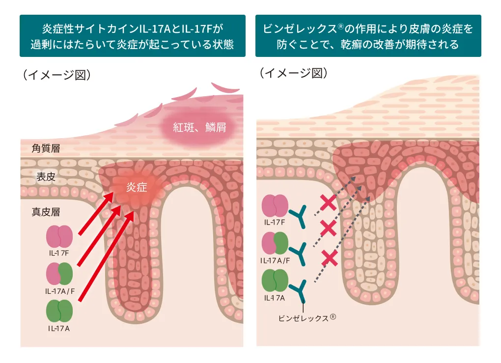 尋常性乾癬などにおけるビンゼレックスの作用機序を示した皮膚断面図