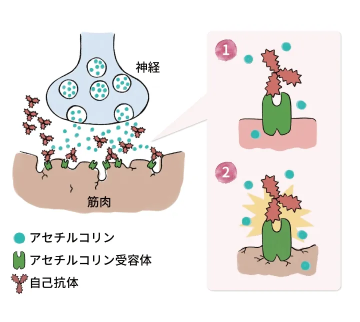 自己抗体によりアセチルコリン受容体が阻害・破壊され、筋肉に指令が伝わりにくくなる仕組みを示す図