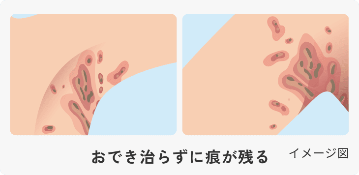 化膿性汗腺炎(HS)の症状で、より広く痕が残った状態を示した図
