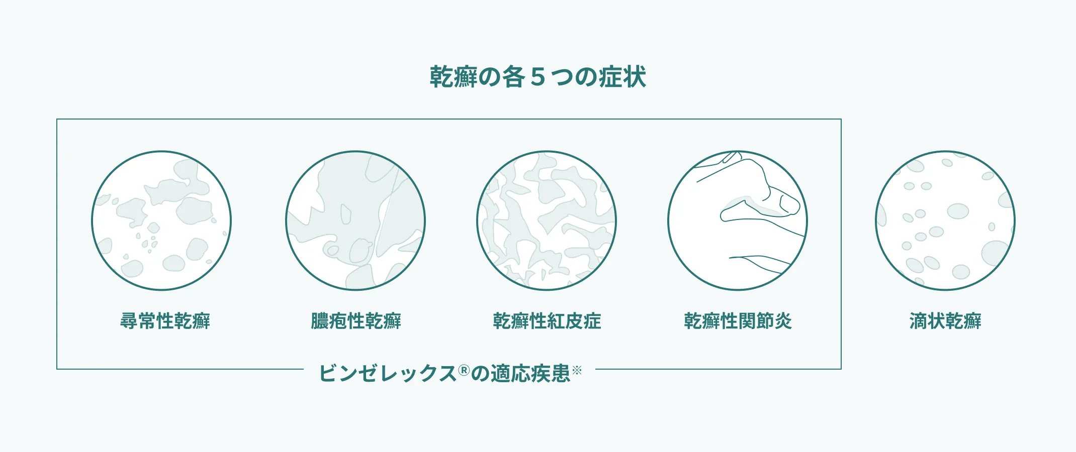 乾癬の5つの種類(尋常性乾癬、膿疱性乾癬、乾癬性紅皮症、乾癬性関節炎、滴状乾癬)