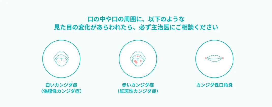 口の中や口の周囲に、以下のような見た目の変化があらわれたら、必ず主治医にご相談ください 白いカンジダ症(偽膜性カンジダ症) 赤いカンジダ症(紅斑性カンジダ症) カンジダ性口角炎