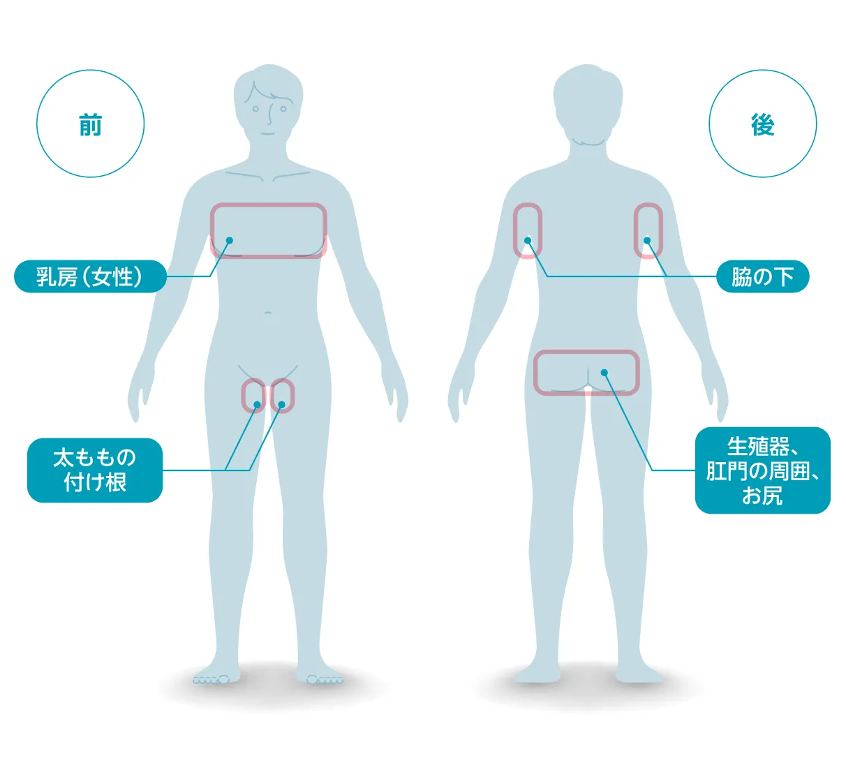 HSができやすい部位を示す図。脇の下、乳房(女性)、太ももの付け根、外陰部・肛門周囲・お尻などに発症しやすい