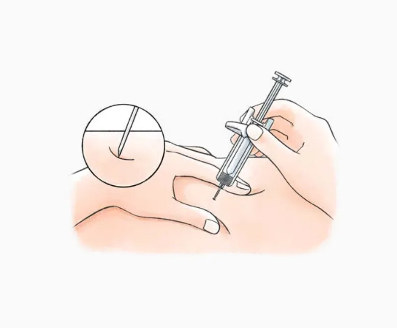 皮膚に対して適切な角度でシリンジを刺入する注射手順を示した図