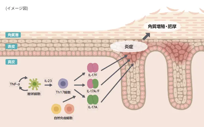 乾癬の発症の仕組みを説明する皮膚断面図
