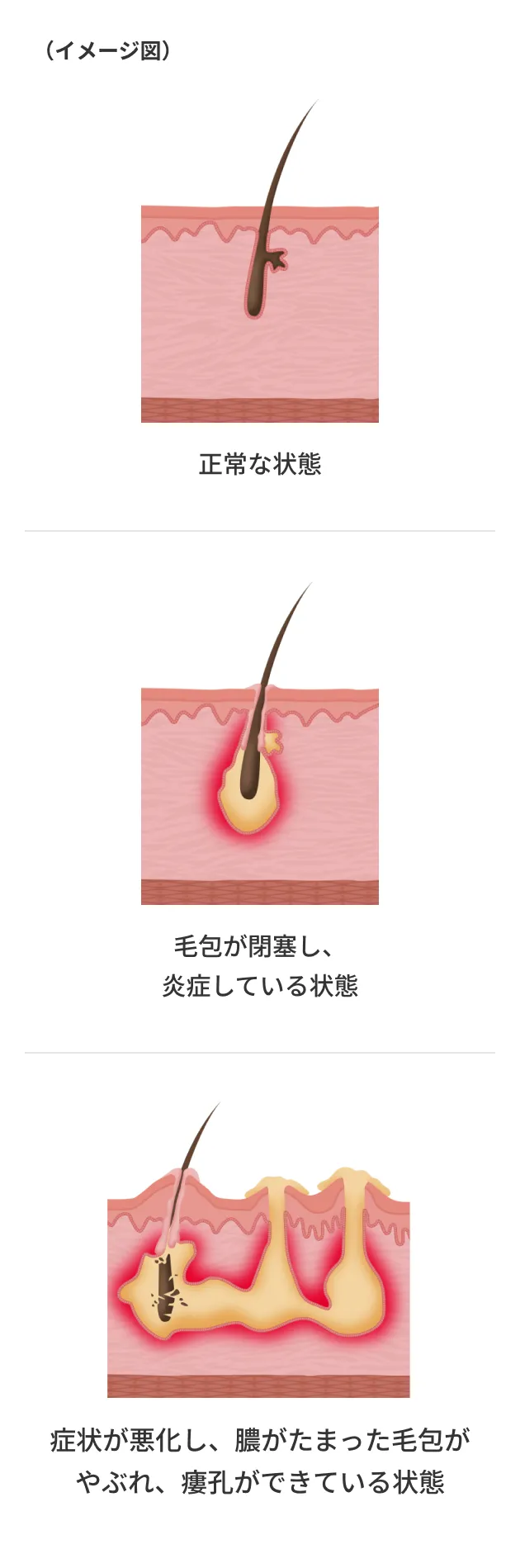 化膿性汗腺炎の発症の流れ(毛穴の詰まりから炎症が起こり、膿がたまって瘻孔ができるまで)を示した図