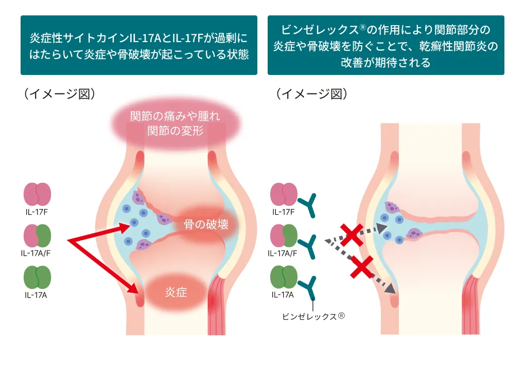 乾癬性関節炎におけるビンゼレックスの作用機序を示した関節の断面図