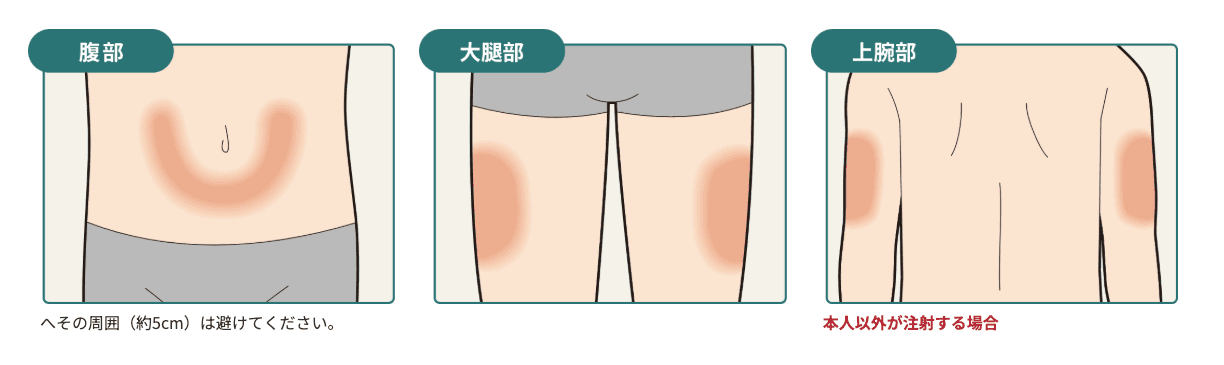 シムジア®の注射部位(腹部、大腿部、上腕部)を示した図