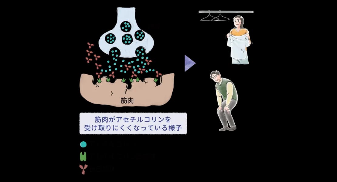 重症筋無力症ではアセチルコリンが筋肉で十分に受け取られず、筋肉が収縮しにくくなる仕組みを示す図